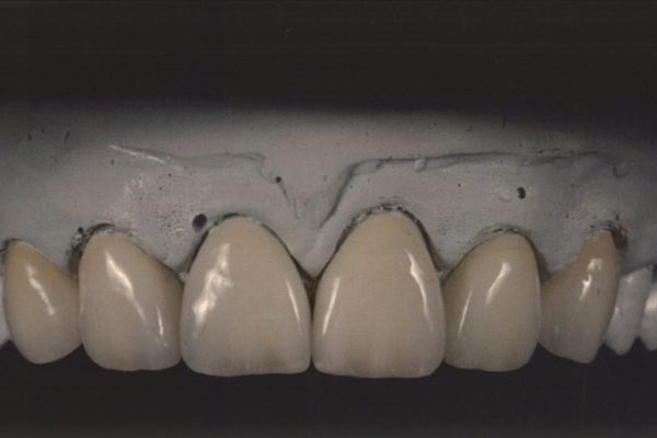 IPS e.max dental crown melbourne