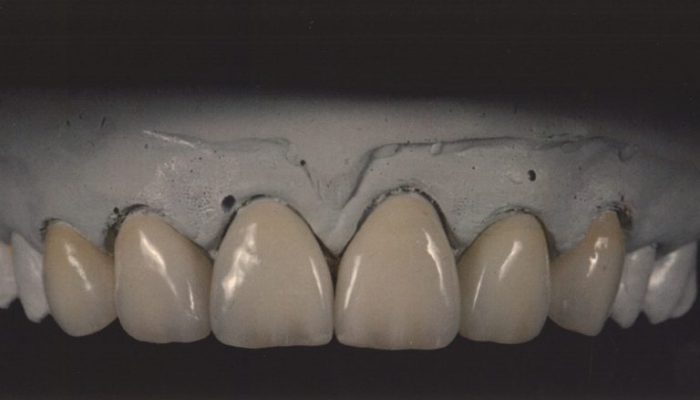 IPS-emax-1-768×453 IPS e.max dental crown melbourne