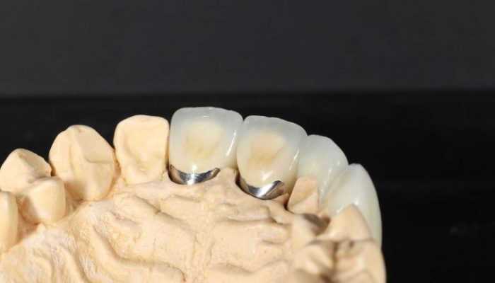 PFM03_Web-768×512 Porcelain Fused to Metal (PFM)