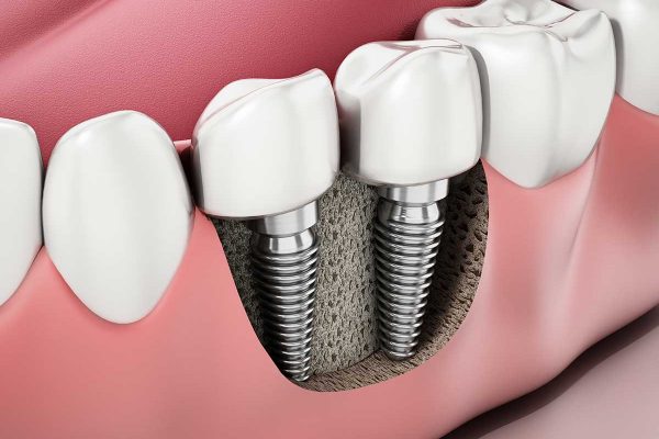 dental implants laboratory melbourne