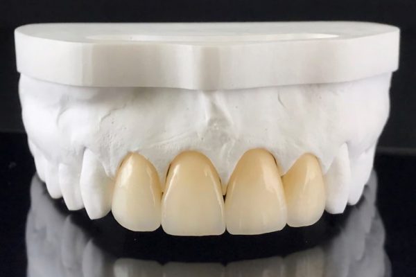 Porcelain Fused to Zirconia (PFZ)
