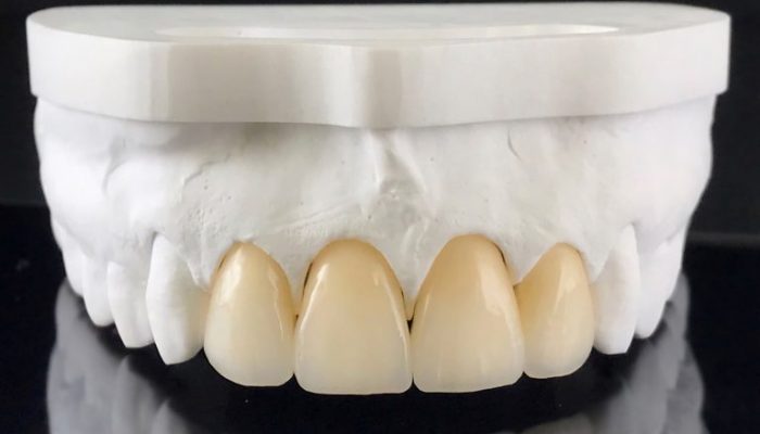 zirconia-crowns-with-full-porcelain-in-the-plaster-2023-06-05-22-26-17-utc-768×523 Porcelain Fused to Zirconia (PFZ)